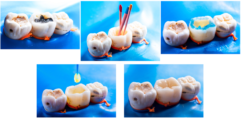 Tratamentul Endodontic